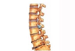 Gimdos kaklelio osteochondrozės vystymosi etapai