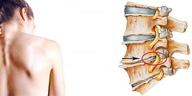Gimdos kaklelio osteochondrozės vystymosi mechanizmas