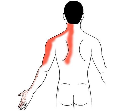 gimdos kaklelio osteochondrozė kaip pirštų sąnarių skausmo priežastis