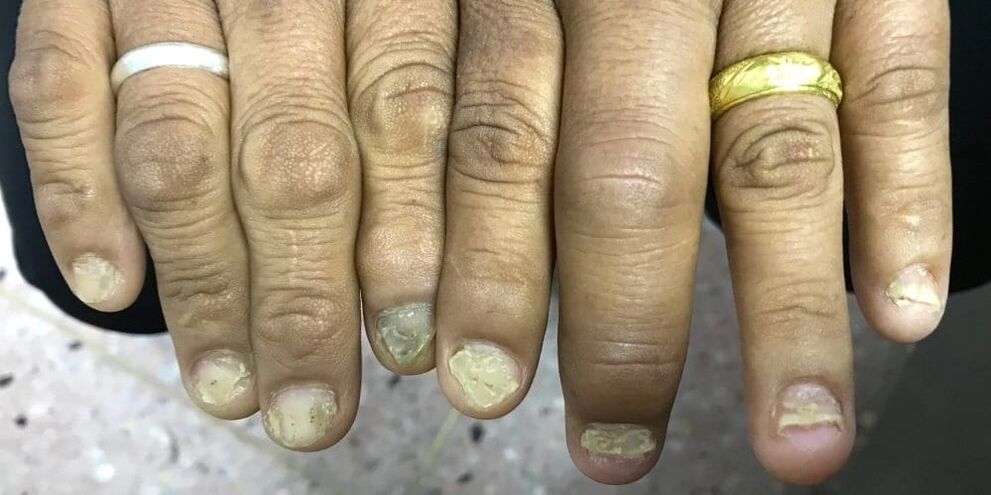 Pirštų patinimas ir nago plokštelės deformacija gali rodyti psoriazinio artrito išsivystymą